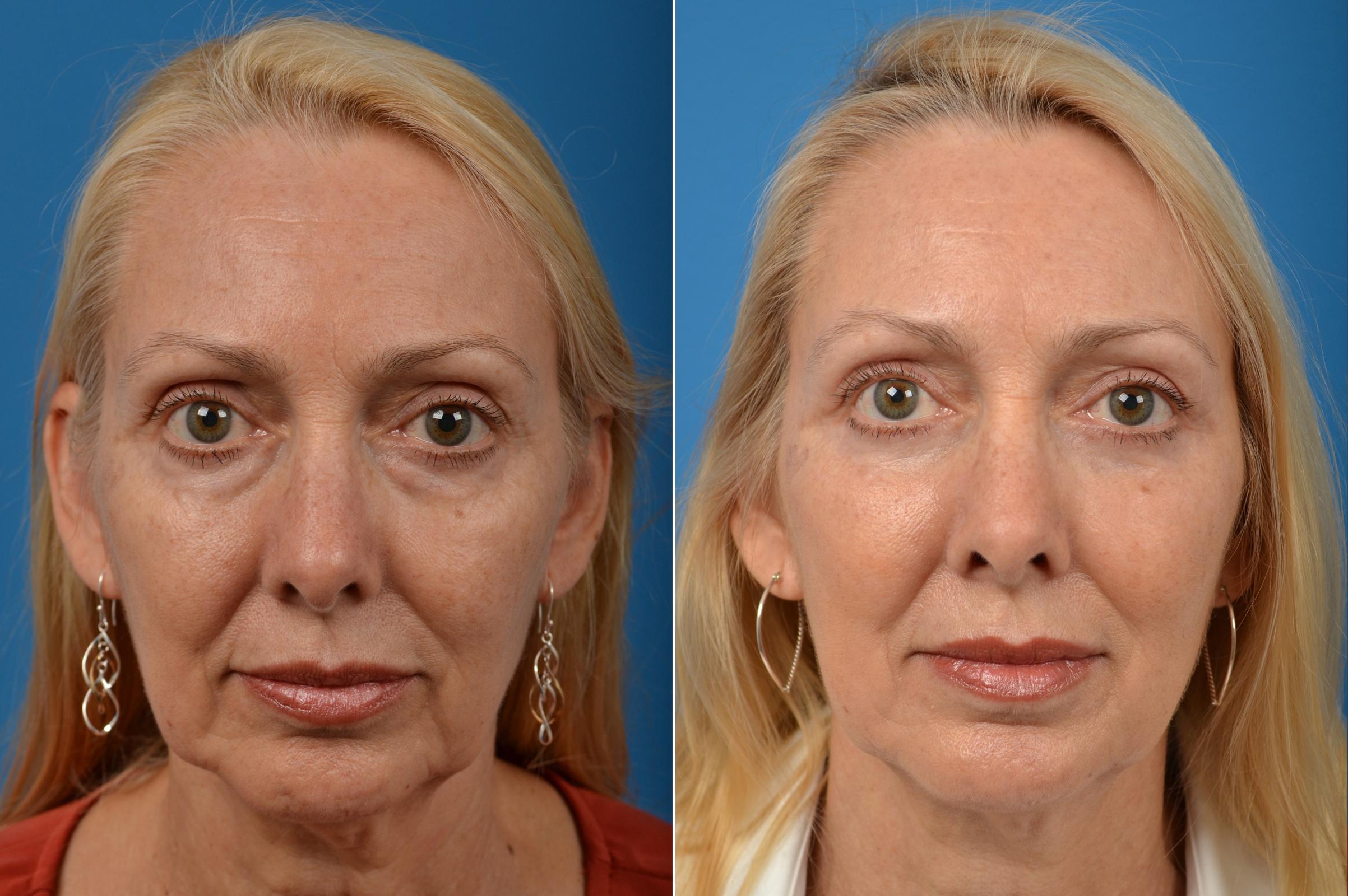 eyelid-surgery-photos-melbourne-fl-patient-60499